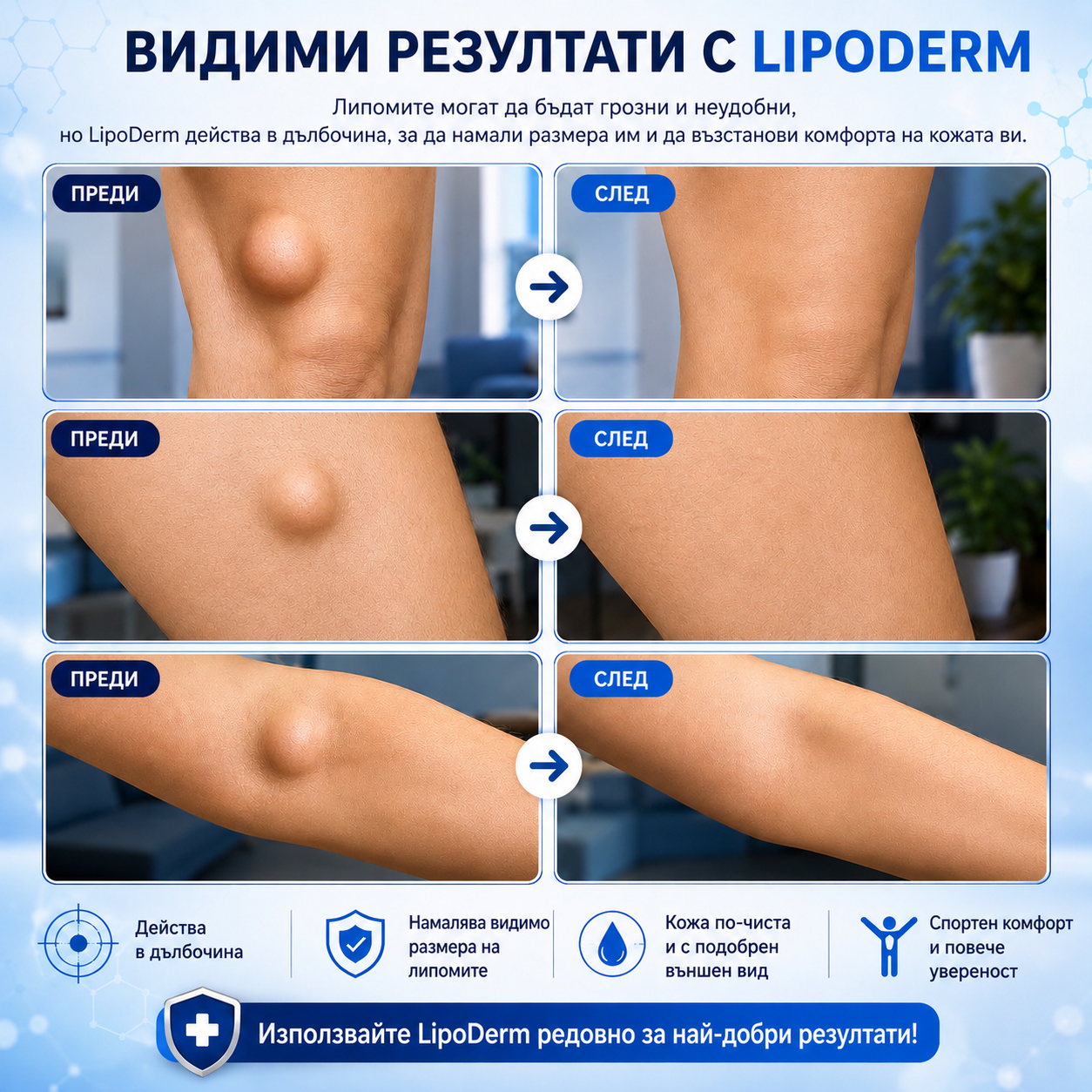 LipoDerm Крем за липоми